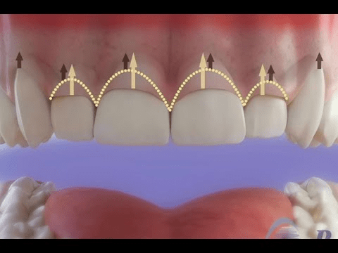 Les suites opératoires d’une gingivectomie