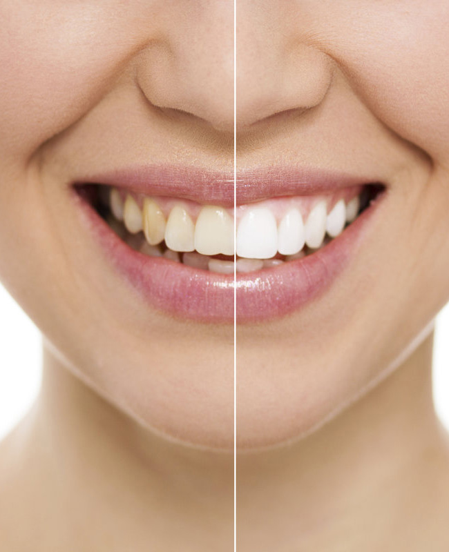 Implant dentaire Tunisie: Posez un implant dentaire et remplacez vos dents manquantes